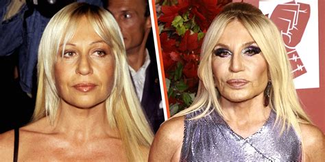 Experts Believe Donatella Versace Had Several Plastic